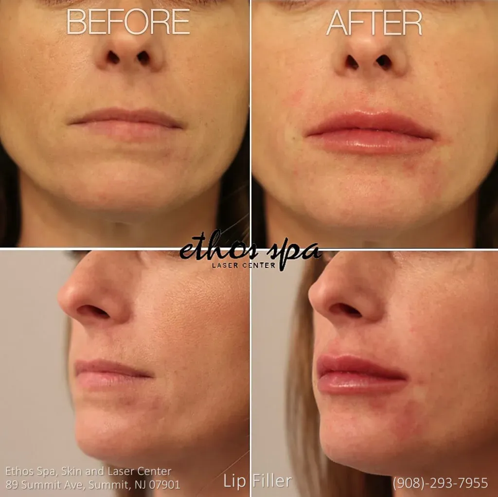 Lip filler before and after, front and profile views