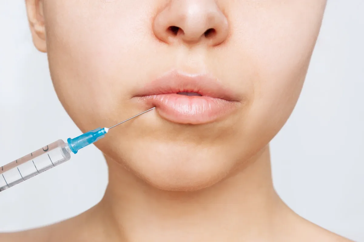 Dental Work After Lip Filler? Here's What You Need to Know