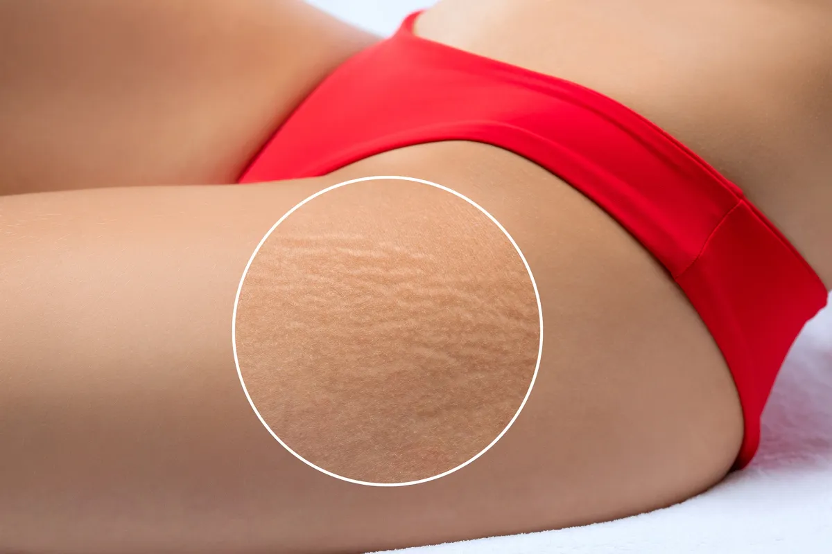 Hives After Laser Hair Removal: How Common Are They Really?