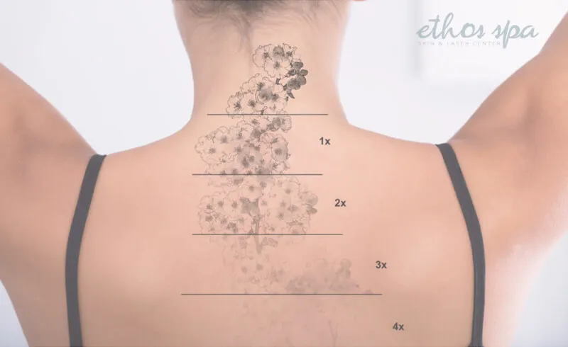 10 Best Ways to Improve Laser Tattoo Removal Process and Fading