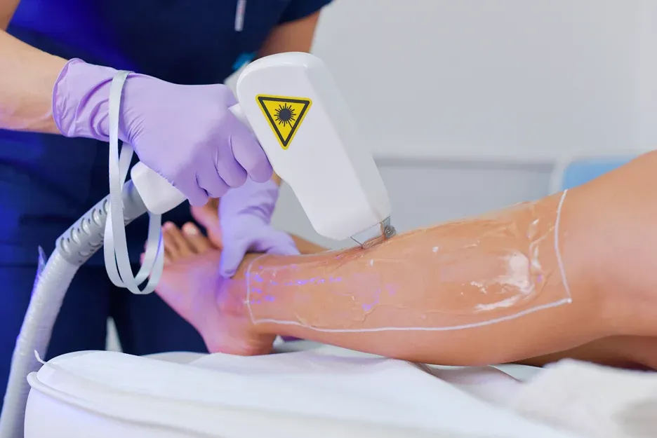 laser hair removal treatment on legs