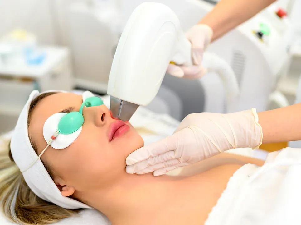 Upper lip laser hair removal on a woman wearing eye shields