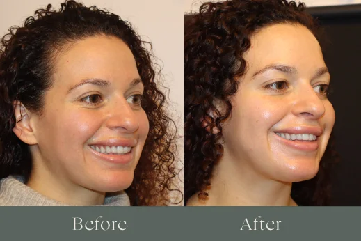 Botox before and after