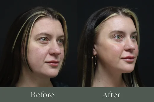 Dermal fillers before and after