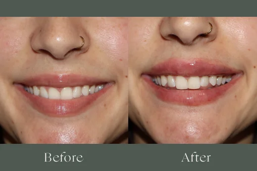 Dermal fillers before and after