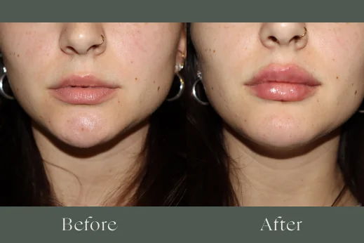 Dermal fillers before and after