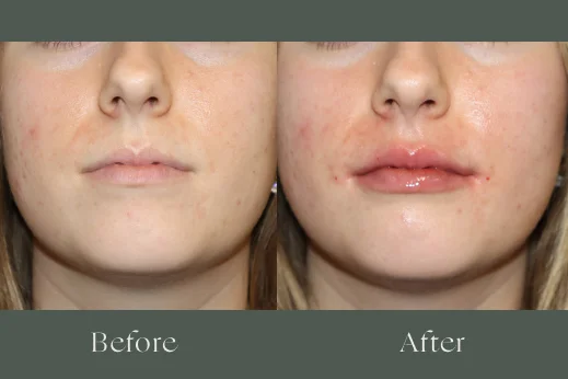 Dermal fillers before and after