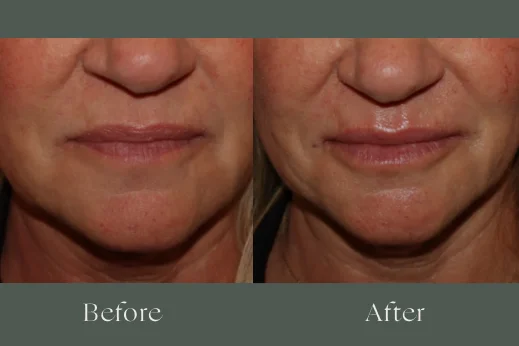 Dermal fillers before and after