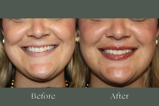 Dermal fillers before and after