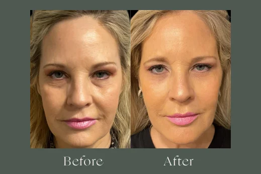 Dermal fillers before and after