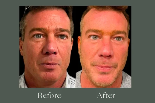 Dermal fillers before and after