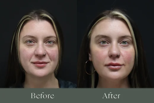 Dermal fillers before and after