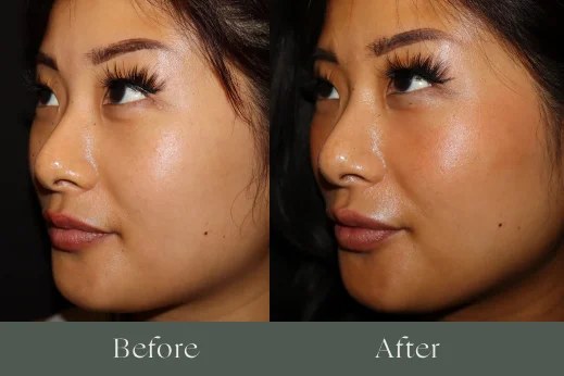 Dermal fillers before and after