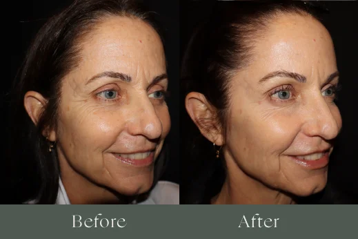 Dermal fillers before and after