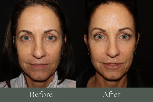 Dermal fillers before and after