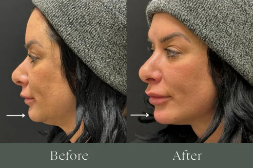 Dermal fillers before and after