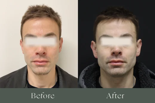 Dermal fillers before and after