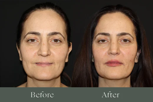Dermal fillers before and after