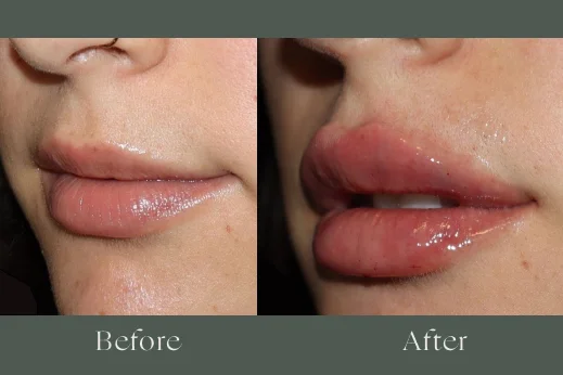 Dermal fillers before and after