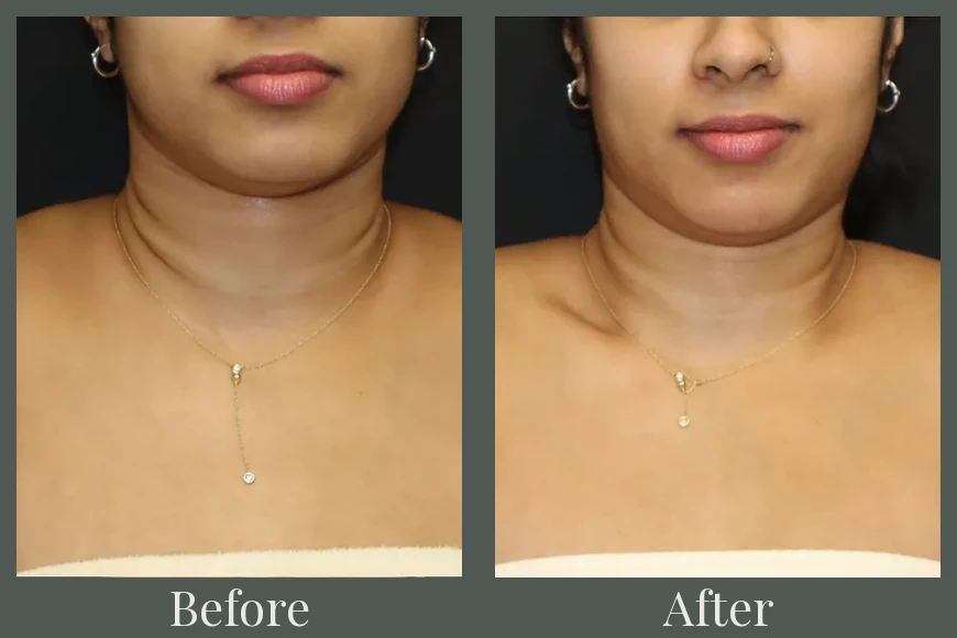 Botox before and after