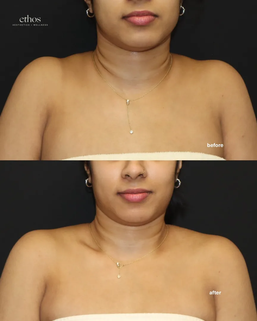Botox before and after