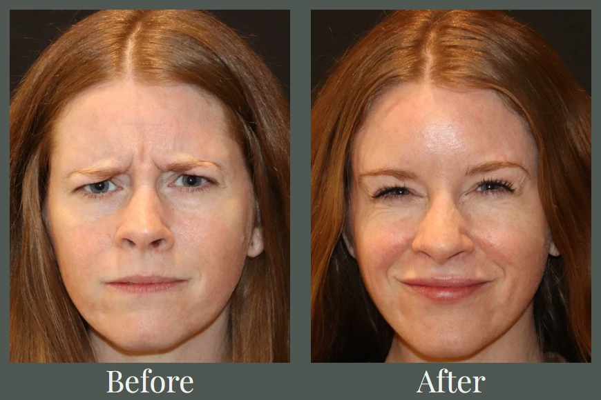 Botox before and after — frown lines smoothed