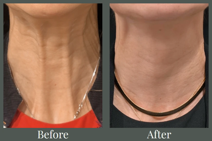 Platysmal band Botox before and after — neck