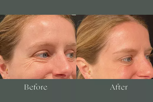 Botox before and after