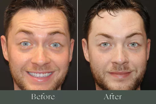 Botox before and after