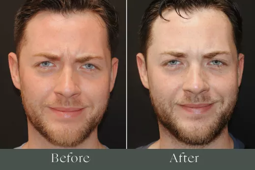 Botox before and after