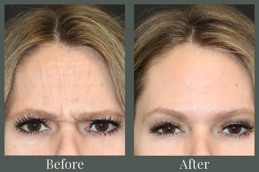 Botox before and after