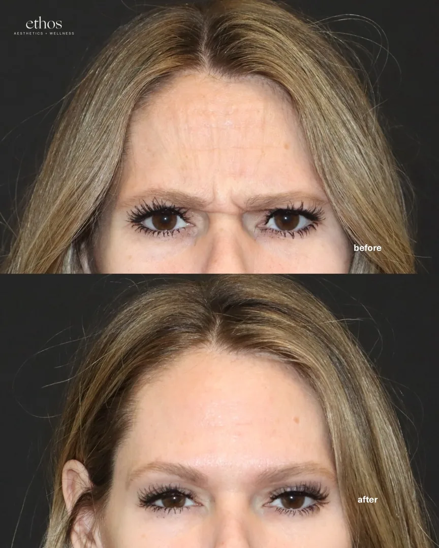 Botox before and after