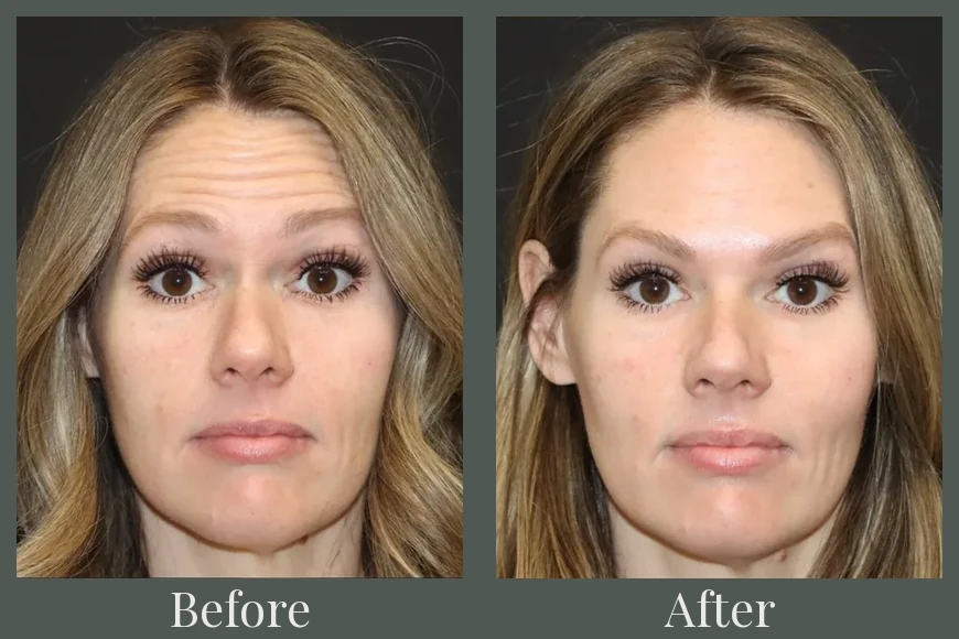 Botox before and after