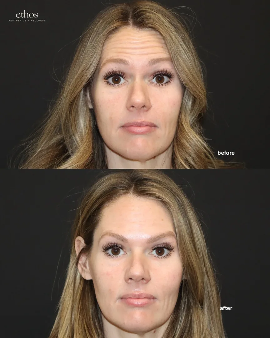 Botox before and after