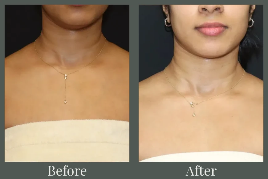 Botox before and after
