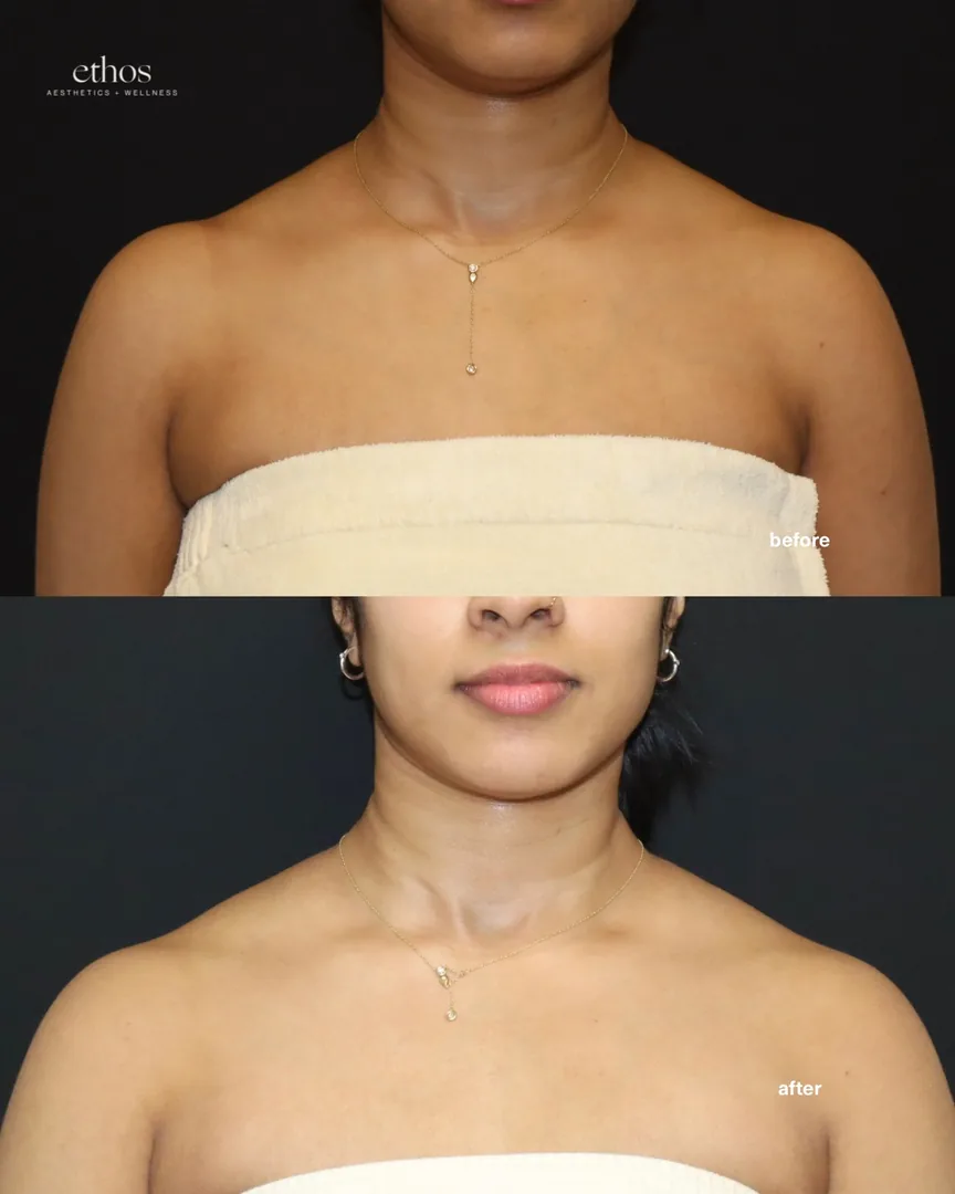 Botox before and after