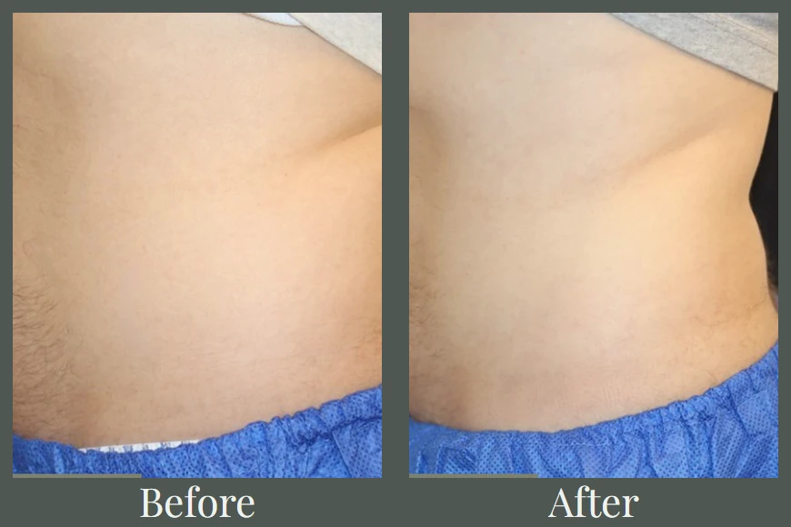 CoolSculpting before and after — abdomen fat reduction