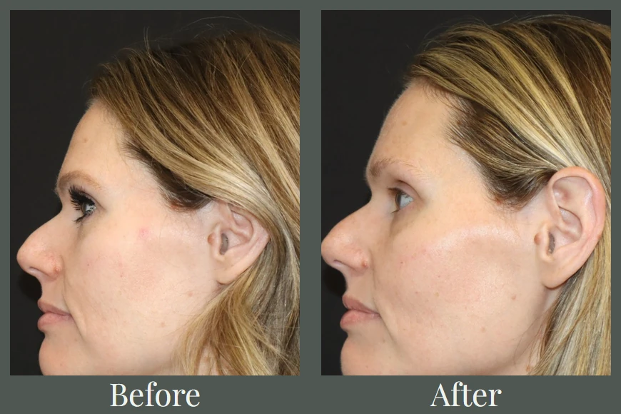 DEJ BioStim before and after — profile