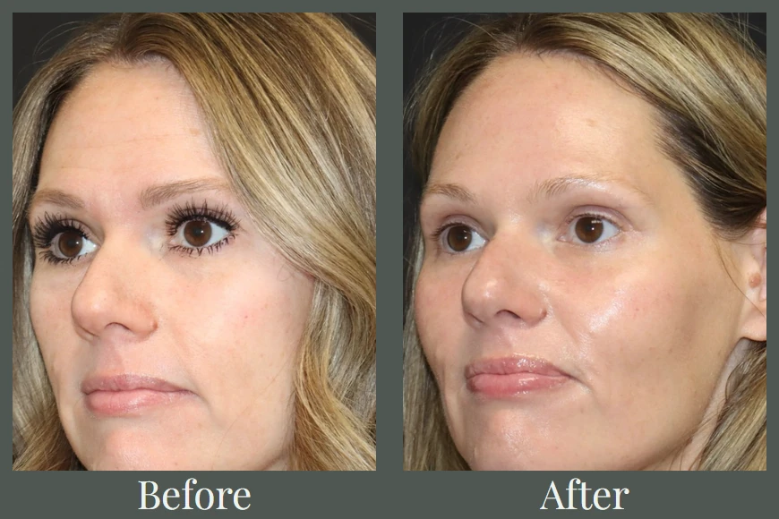 DEJ BioStim before and after — three-quarter view