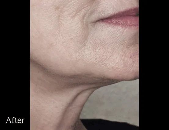 Density skin tightening before and after — jawline and lower face