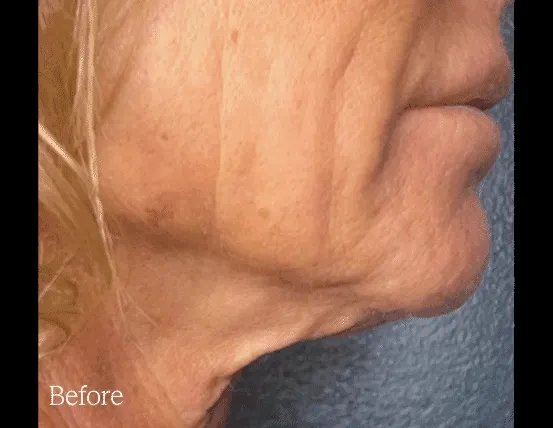 Density skin tightening before and after — neck and jawline