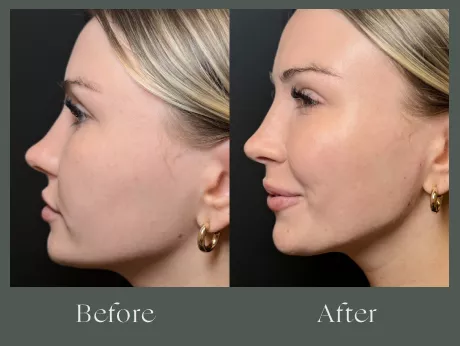 Jawline filler before and after