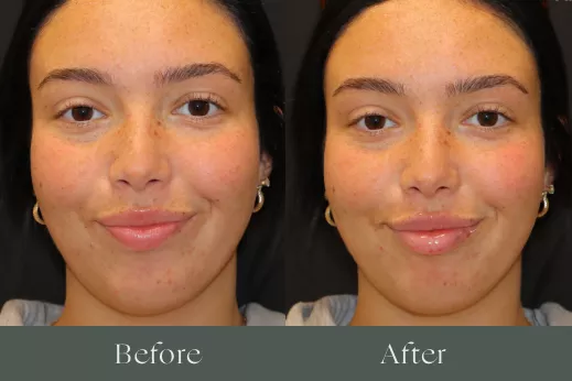 Lip filler before and after