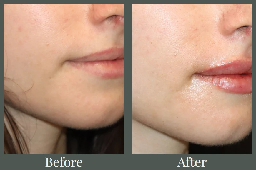 Lip filler before and after — close-up