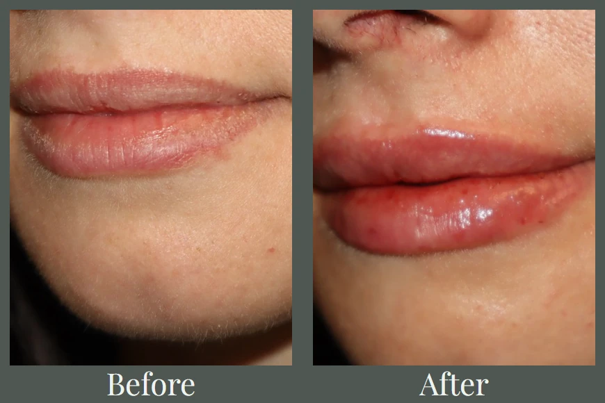 Lip filler before and after — close-up