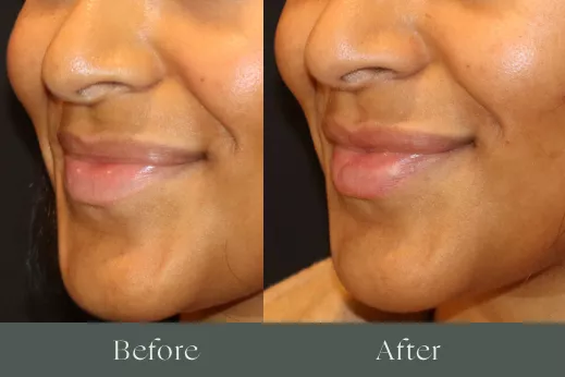 Lip filler before and after