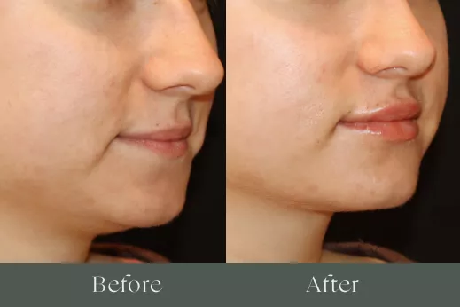 Lip filler before and after