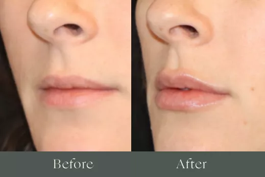 Lip filler before and after
