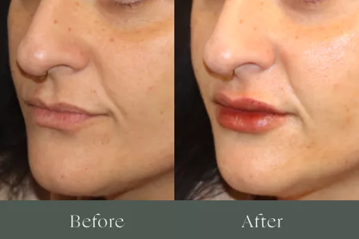 Lip filler before and after