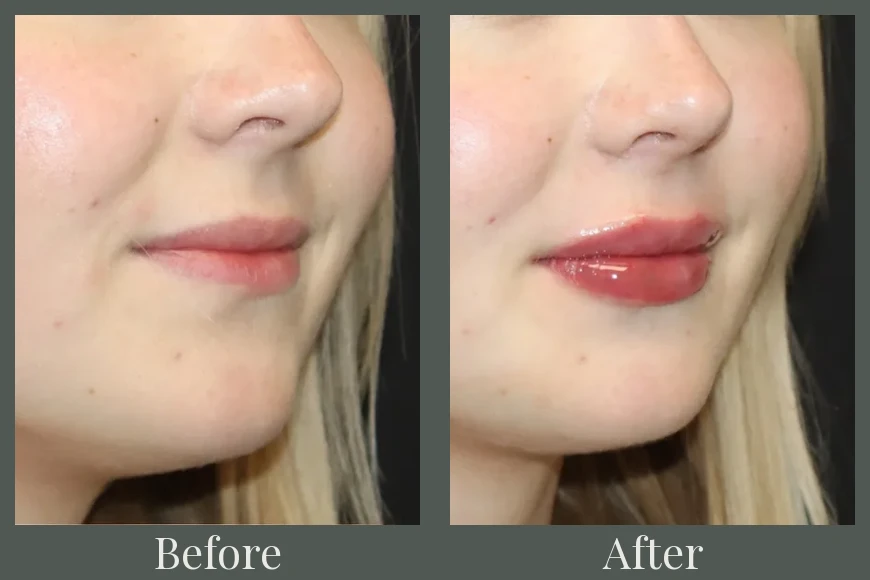 Lip filler before and after